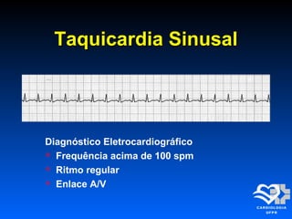 Taquicardia SinusalTaquicardia Sinusal
Diagnóstico Eletrocardiográfico
 Frequência acima de 100 spm
 Ritmo regular
 Enlace A/V
 