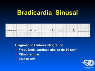 Bradicardia SinusalBradicardia Sinusal
Diagnóstico Eletrocardiográfico
 Frequência cardíaca abaixo de 60 spm
 Ritmo regular
 Enlace A/V
 