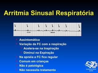 Arritmia Sinusal RespiratóriaArritmia Sinusal Respiratória
 Assintomática
 Variação da FC com a respiração
 Acelera-se na Inspiração
 Diminui na Expiração
 Na apnéia a FC fica regular
 Comum em crianças
 Não é patológica
 Não necessita tratamento
 