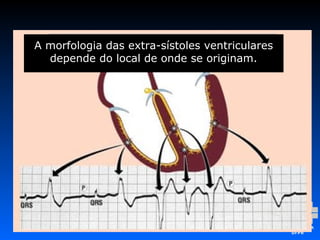 A morfologia das extra-sístoles ventriculares
depende do local de onde se originam.
 