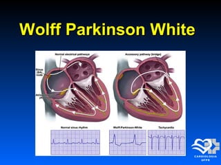 Wolff Parkinson WhiteWolff Parkinson White
 