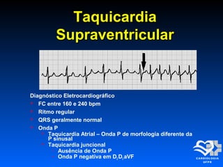 TaquicardiaTaquicardia
SupraventricularSupraventricular
Diagnóstico Eletrocardiográfico
 FC entre 160 e 240 bpm
 Ritmo regular
 QRS geralmente normal
 Onda P
 Taquicardia Atrial – Onda P de morfologia diferente da
P sinusal
 Taquicardia juncional
 Ausência de Onda P
 Onda P negativa em D2 D3 aVF
 
 