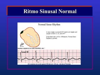 Arritmias Cardiacas | PPT