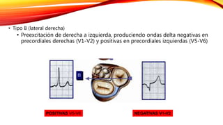 • Tipo B (lateral derecha)
• Preexcitación de derecha a izquierda, produciendo ondas delta negativas en
precordiales derechas (V1-V2) y positivas en precordiales izquierdas (V5-V6)
NEGATIVAS V1-V2POSITIVAS V5-V6
 