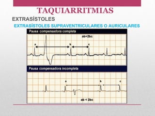 EXTRASÍSTOLES SUPRAVENTRICULARES O AURICULARES
TAQUIARRITMIAS
EXTRASÍSTOLES
 