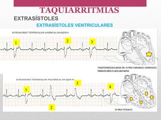 1 2 3
1
2
3
4
EXTRASÍSTOLES VENTRICULARES
TAQUIARRITMIAS
EXTRASÍSTOLES
 
