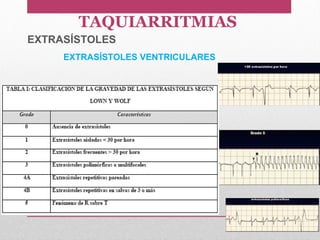 EXTRASÍSTOLES VENTRICULARES
TAQUIARRITMIAS
EXTRASÍSTOLES
 