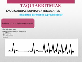 TAQUICARDIAS SUPRAVENTRICULARES
Taquicardia paroxística supraventricular
TAQUIARRITMIAS
 