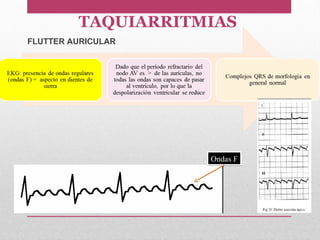 Ondas FOndas F
FLUTTER AURICULAR
TAQUIARRITMIAS
 