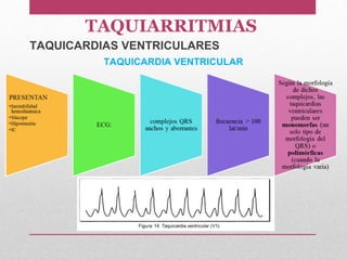 TAQUICARDIA VENTRICULAR
TAQUICARDIAS VENTRICULARES
TAQUIARRITMIAS
 