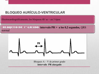 BRADIARRITMIAS
BLOQUEO AURÍCULO-VENTRICULAR
Bloqueo A – V de primer grado
intervalo PR alargado
 