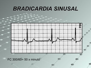 BRADICARDIA SINUSAL FC 300/60= 50 x minuto 