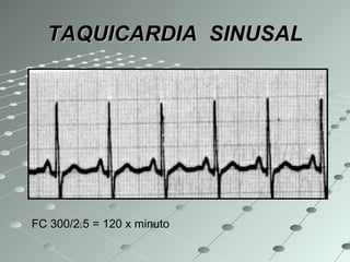TAQUICARDIA  SINUSAL FC 300/2.5 = 120 x minuto 