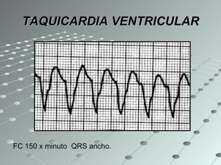 TAQUICARDIA VENTRICULAR FC 150 x minuto  QRS ancho. 