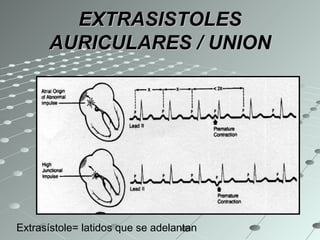 EXTRASISTOLES AURICULARES / UNION Extrasístole= latidos que se adelantan  