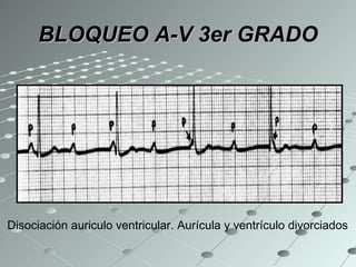 BLOQUEO A-V 3er GRADO Disociación auriculo ventricular. Aurícula y ventrículo divorciados 