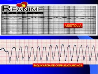 ASISTOLIA
TAQUICARDIA DE COMPLEJOS ANCHOS
 