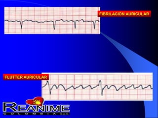 FIBRILACIÓN AURICULAR
FLUTTER AURICULAR
 
