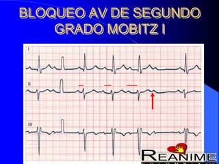 BLOQUEO AV DE SEGUNDO
GRADO MOBITZ I
 