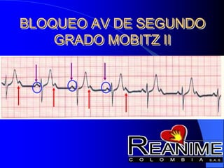 BLOQUEO AV DE SEGUNDO
GRADO MOBITZ II
 