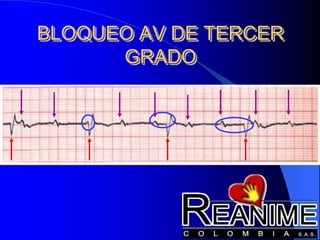BLOQUEO AV DE TERCER
GRADO
 