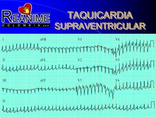 TAQUICARDIA
SUPRAVENTRICULAR
 