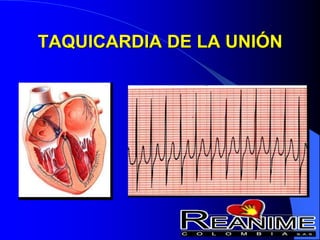 TAQUICARDIA DE LA UNIÓN
 