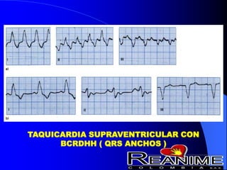 TAQUICARDIA SUPRAVENTRICULAR CON
BCRDHH ( QRS ANCHOS )
 