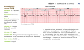 Normal Rsn Face ARRITMIAS HUSZAR electrocardiograma interpretacion | PDF