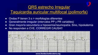 www.fundacionfavaloro.org
QRS estrecho Irregular
Taquicardia auricular multifocal (polimorfa)
● Ondas P tienen 3 o > morfologías diferentes
● Generalmente irregular (intervalos PP y PR variables)
● Gran mayoría secundaria a hipoxemia/neumopatía. Sino, hipokalemia
● No responden a CVE, CORREGIR CAUSA!!
 