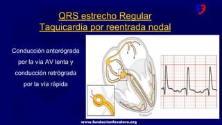 www.fundacionfavaloro.org
Conducción anterógrada
por la vía AV lenta y
conducción retrógrada
por la vía rápida
QRS estrecho Regular
Taquicardia por reentrada nodal
 