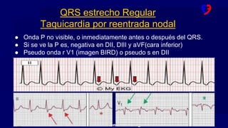 www.fundacionfavaloro.org
● Onda P no visible, o inmediatamente antes o después del QRS.
● Si se ve la P es, negativa en DII, DIII y aVF(cara inferior)
● Pseudo onda r V1 (imagen BIRD) o pseudo s en DII
QRS estrecho Regular
Taquicardia por reentrada nodal
 