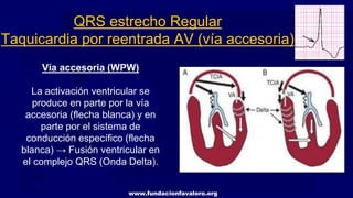 www.fundacionfavaloro.org
QRS estrecho Regular
Taquicardia por reentrada AV (vía accesoria)
Vía accesoria (WPW)
La activación ventricular se
produce en parte por la vía
accesoria (flecha blanca) y en
parte por el sistema de
conducción específico (flecha
blanca) → Fusión ventricular en
el complejo QRS (Onda Delta).
 