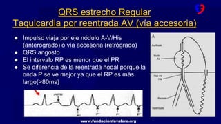 www.fundacionfavaloro.org
● Impulso viaja por eje nódulo A-V/His
(anterogrado) o vía accesoria (retrógrado)
● QRS angosto
● El intervalo RP es menor que el PR
● Se diferencia de la reentrada nodal porque la
onda P se ve mejor ya que el RP es más
largo(>80ms)
QRS estrecho Regular
Taquicardia por reentrada AV (vía accesoria)
 