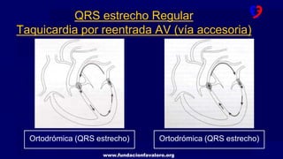 www.fundacionfavaloro.org
QRS estrecho Regular
Taquicardia por reentrada AV (vía accesoria)
Ortodrómica (QRS estrecho) Ortodrómica (QRS estrecho)
 