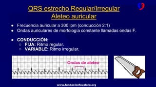 www.fundacionfavaloro.org
QRS estrecho Regular/Irregular
Aleteo auricular
● Frecuencia auricular a 300 lpm (conducción 2:1)
● Ondas auriculares de morfología constante llamadas ondas F.
● CONDUCCIÓN:
○ FIJA: Ritmo regular.
○ VARIABLE: Ritmo irregular.
 