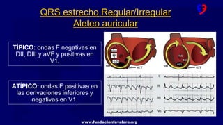 www.fundacionfavaloro.org
TÍPICO: ondas F negativas en
DII, DIII y aVF y positivas en
V1.
QRS estrecho Regular/Irregular
Aleteo auricular
ATÍPICO: ondas F positivas en
las derivaciones inferiores y
negativas en V1.
 