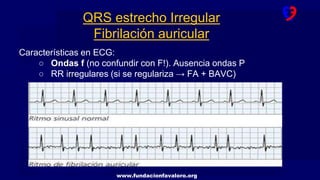 www.fundacionfavaloro.org
Características en ECG:
○ Ondas f (no confundir con F!). Ausencia ondas P
○ RR irregulares (si se regulariza → FA + BAVC)
QRS estrecho Irregular
Fibrilación auricular
 