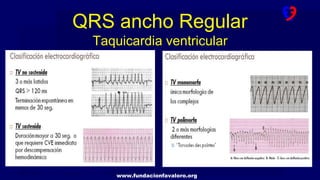 www.fundacionfavaloro.org
QRS ancho Regular
Taquicardia ventricular
 