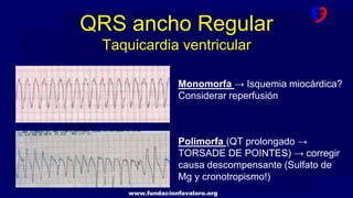 www.fundacionfavaloro.org
Monomorfa → Isquemia miocárdica?
Considerar reperfusión
Polimorfa (QT prolongado →
TORSADE DE POINTES) → corregir
causa descompensante (Sulfato de
Mg y cronotropismo!)
QRS ancho Regular
Taquicardia ventricular
 