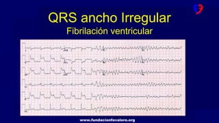 www.fundacionfavaloro.org
QRS ancho Irregular
Fibrilación ventricular
 