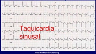 www.fundacionfavaloro.org
Taquicardia
sinusal
 