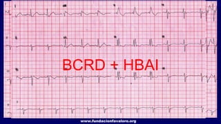 www.fundacionfavaloro.org
Taquicardia
sinusalTA
Taquicardia
supraventricular con
aberrancia
BCRD + HBAI
 