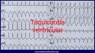 www.fundacionfavaloro.org
Taquicardia
ventricular
 