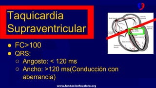 www.fundacionfavaloro.org
Taquicardia
Supraventricular
● FC>100
● QRS:
○ Angosto: < 120 ms
○ Ancho: >120 ms(Conducción con
aberrancia)
 