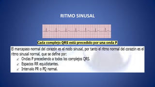 Arritmias | PDF