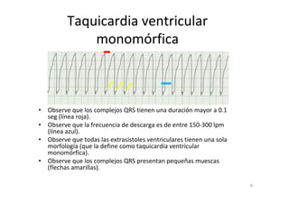 6
Taquicardia ventricular
monomórfica
• Observe que los complejos QRS tienen una duración mayor a 0.1
seg (línea roja).
• Observe que la frecuencia de descarga es de entre 150-300 lpm
(línea azul).
• Observe que todas las extrasístoles ventriculares tienen una sola
morfología (que la define como taquicardia ventricular
monomórfica).
• Observe que los complejos QRS presentan pequeñas muescas
(flechas amarillas).
 