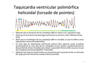 8
Taquicardia ventricular polimórfica
helicoidal (torsade de pointes)
• Observe que la duración de los complejos QRS es mayor a 0.1 seg (línea roja).
• Note que la frecuencia de descarga ventricular es de entre 150 y 300 lpm (línea
azul).
• Note que la morfología de los complejos QRS es variable, lo que la define como
taquicardia ventricular polimórfica.
• En este tipo de taquicardia ventricular polim ó rfica observe como el voltaje
primeramente es muy alto de los complejos (línea verde) y posteriormente va
descendiendo (línea morada) para volver a ascender (línea verde oscuro), lo que
da el aspecto electrocariográfico “helicoidal”.
• Además este tipo de taquiarritmia se caracteriza por la presencia de un intervalo
QT largo para la frecuencia cardiaca (línea amarilla).
 