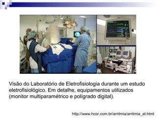 Visão do Laboratório de Eletrofisiologia durante um estudo
eletrofisiológico. Em detalhe, equipamentos utilizados
(monitor multiparamétrico e polígrado digital).
http://www.hcor.com.br/arritmia/arritmia_at.html

 