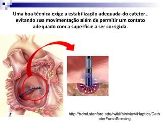 Uma boa técnica exige a estabilização adequada do cateter ,
evitando sua movimentação além de permitir um contato
adequado com a superfície a ser corrigida.

http://bdml.stanford.edu/twiki/bin/view/Haptics/Cath
eterForceSensing

 